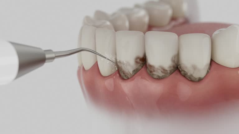 Trusted Wisdom Tooth Removal service in Santa Rosa, CA - Dentist Open Now